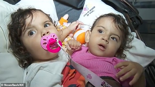 Siamese twins Kiraz (left) and Aruna (right), aged 1 year and 6 months