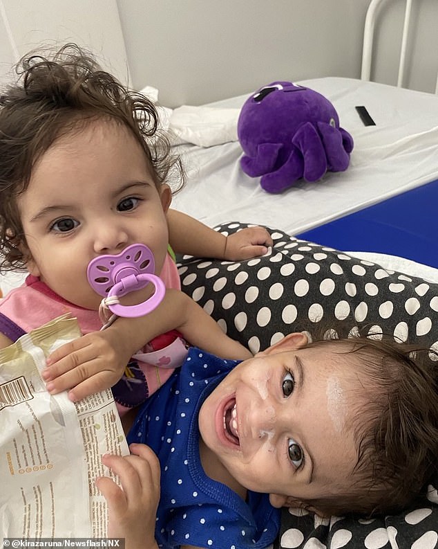 Aruna and Kiraz were born conjoined at the thorax, abdomen, and pelvis and underwent the procedure at 18 months old