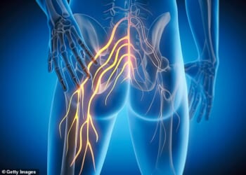 Sciatica occurs when the roots of the sciatic nerve ¿ which runs from the lower back down through the hips and legs ¿ become inflamed or compressed