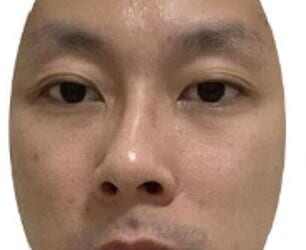 Picture A: Do you think this person looks particularly ill, compared to the next photo?