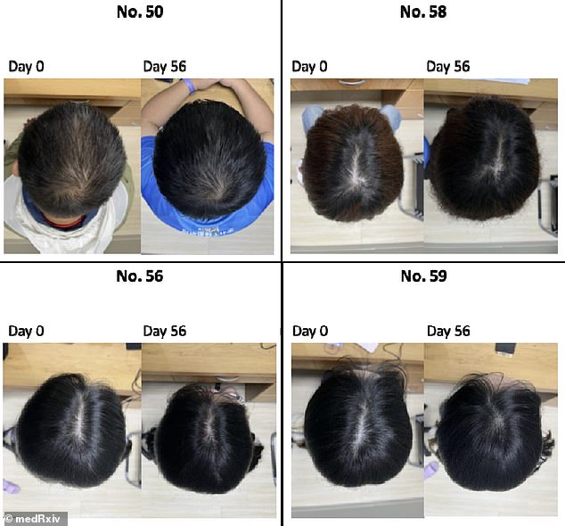 Scalp photographs from Day 0 (left) and Day 56 (right) show the results for participants using the complete serum¿a blend of growth factors, plant vesicles, caffeine, and panthenol. The after images reveal enhanced hair coverage and density, most notably at the vertex (crown of the head).