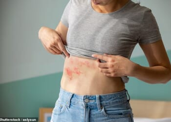 Shingles, which appears as a painful, blistering rash, is caused by the varicella-zoster virus, which most people first encounter in childhood as chickenpox