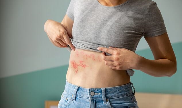 Shingles, which appears as a painful, blistering rash, is caused by the varicella-zoster virus, which most people first encounter in childhood as chickenpox