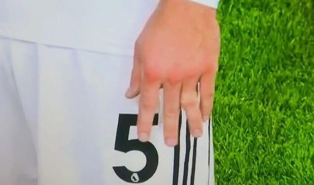 Joachim Andersen appeared to dislocate a finger during Fulham's tie with Nottingham Forest