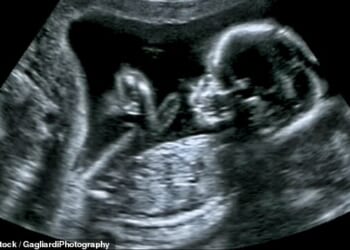 Britain's leading abortion charity has been criticised for encouraging 'sex-selective' terminations. Pictured: An ultrasound of a baby in a womb