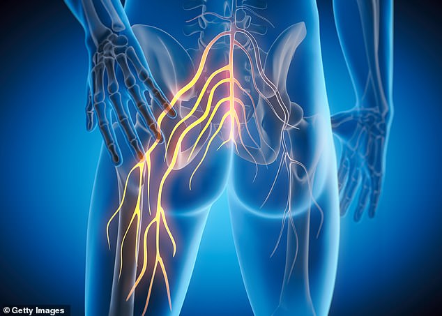 Sciatica occurs when the roots of the sciatic nerve ¿ which runs from the lower back down through the hips and legs ¿ become inflamed or compressed