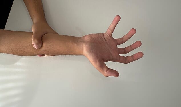 A man in Ireland was diagnosed with alien hand syndrome, an extremely rare condition in which a person's hand moves on its own uncontrollably. Only 50 cases have been identified (stock image)