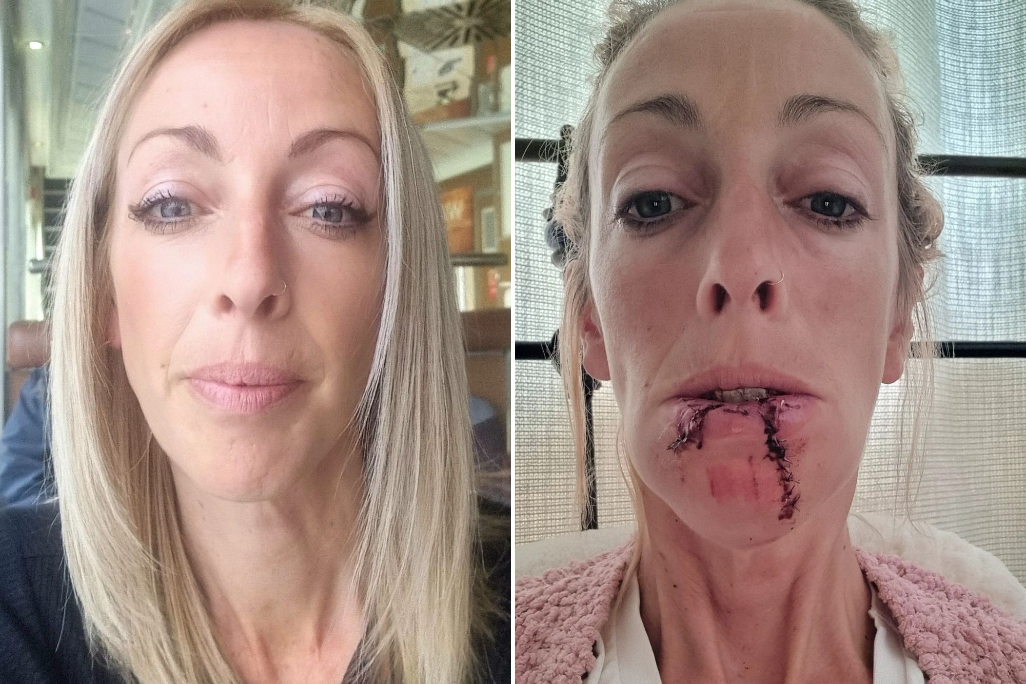 An image collage containing 2 images, Image 1 shows Lauren Chandler, a care worker with facial injuries from a dog attack, Image 2 shows Lauren Chandler with stitches and open wounds on her chin and lower lip