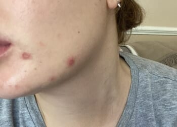 Madeleine suffered from acne for years. Having mild polycystic ovary syndrome (PCOS) makes her more prone to spots