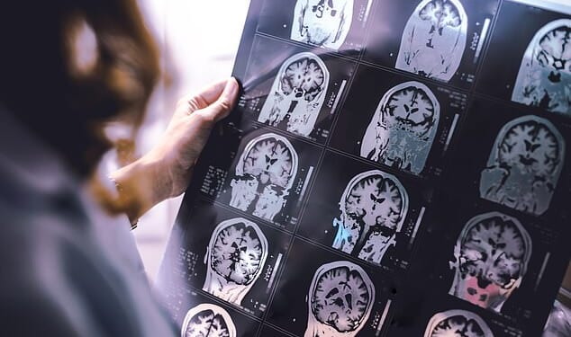 British researchers say a cure for Alzheimer'sdisease could one day be possible, with experts suggesting truly life-changing treatments may emerge within the next five to ten years