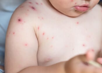 New MMRV jab that protects against chickenpox available on NHS today