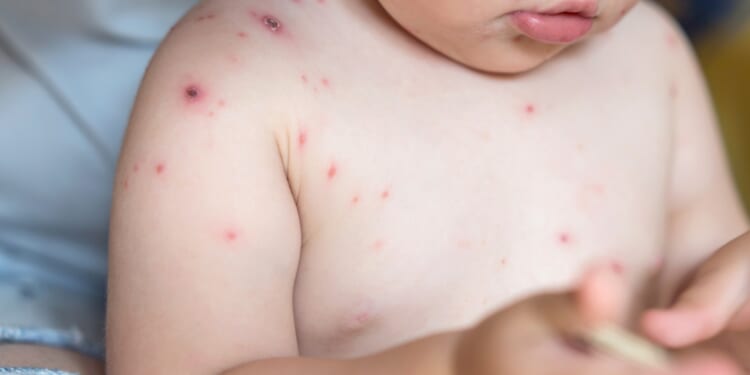New MMRV jab that protects against chickenpox available on NHS today