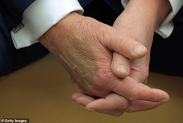 Trump has taken to applying concealer and foundation to cover up the discoloration on his hands ¿ though the makeup often does not match his skin tone and is as obvious as bruising