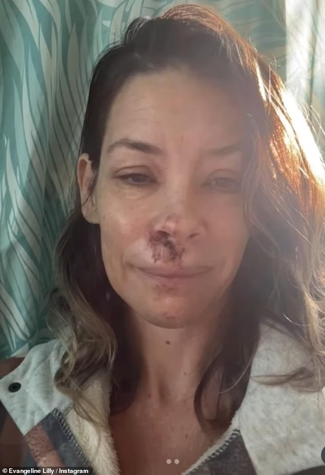 The revelation comes nearly seven months after she shared shocking photos of her facial injuriesfollowing a horrific fall at the beach