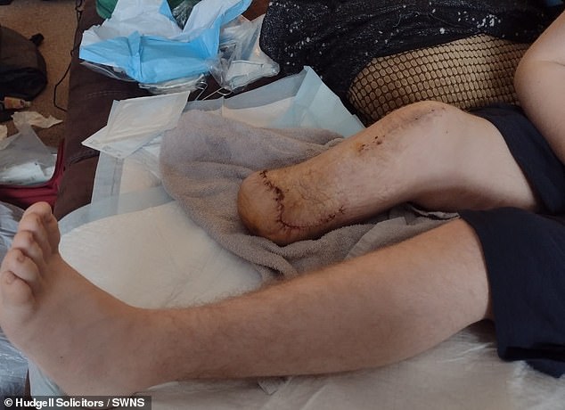 Pictured is the teenage boy after he had his leg amputated below the knee
