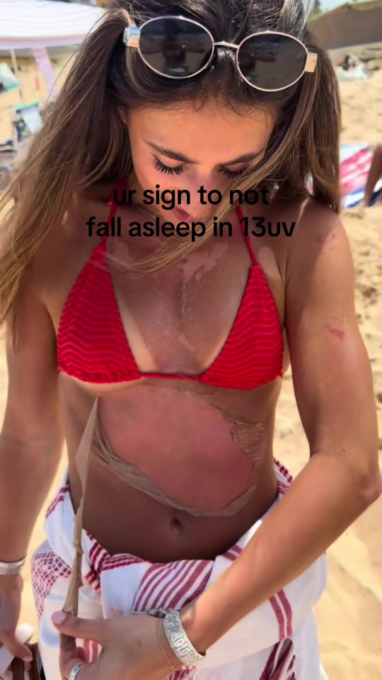 A woman's chest and stomach showing severe sunburn and peeling skin from her chest down to her stomach, with text overlay.