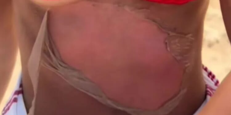 Watch as woman PEELS off her own skin after falling asleep in the sunshine & leaves viewers jaws on the floor