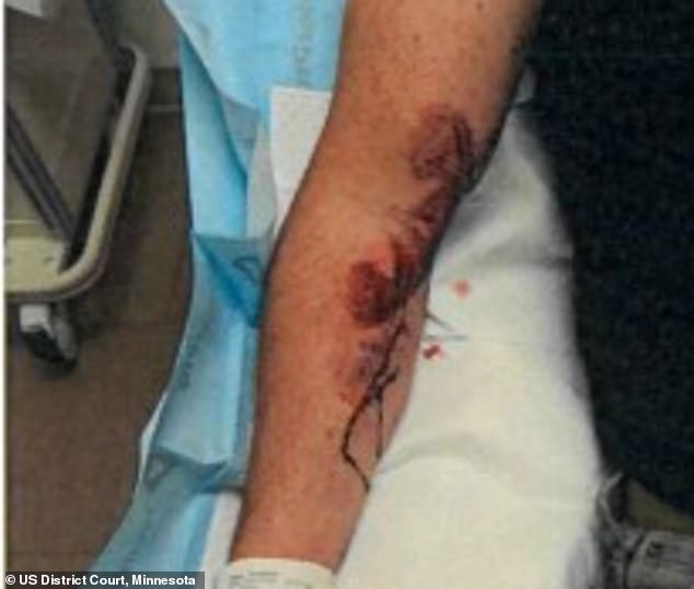 The officer's arm injury after being dragged for 100 yards in Bloomington in June