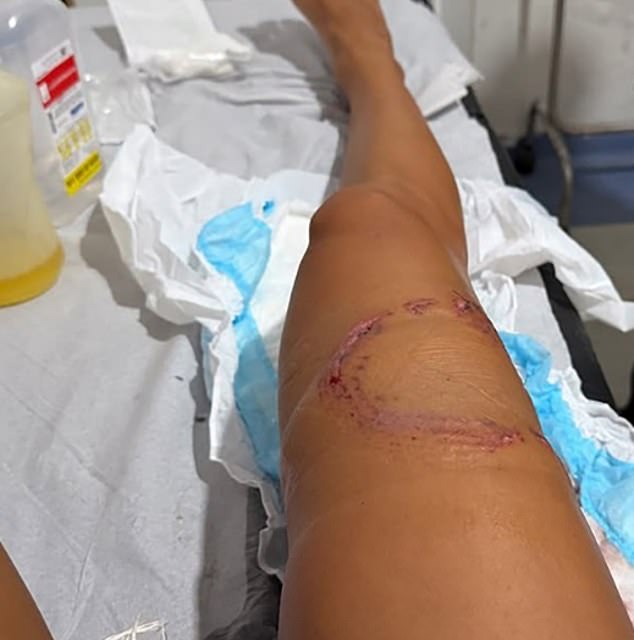 The gruesome photos show numerous puncture wounds on her leg