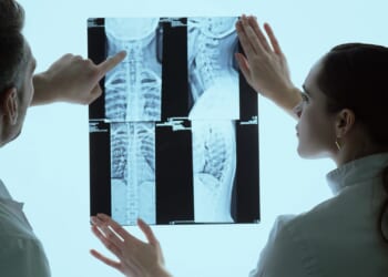 Is your back pain a spinal FRACTURE? Staggering 2.2million Brits 'living with hidden, agonising' breaks