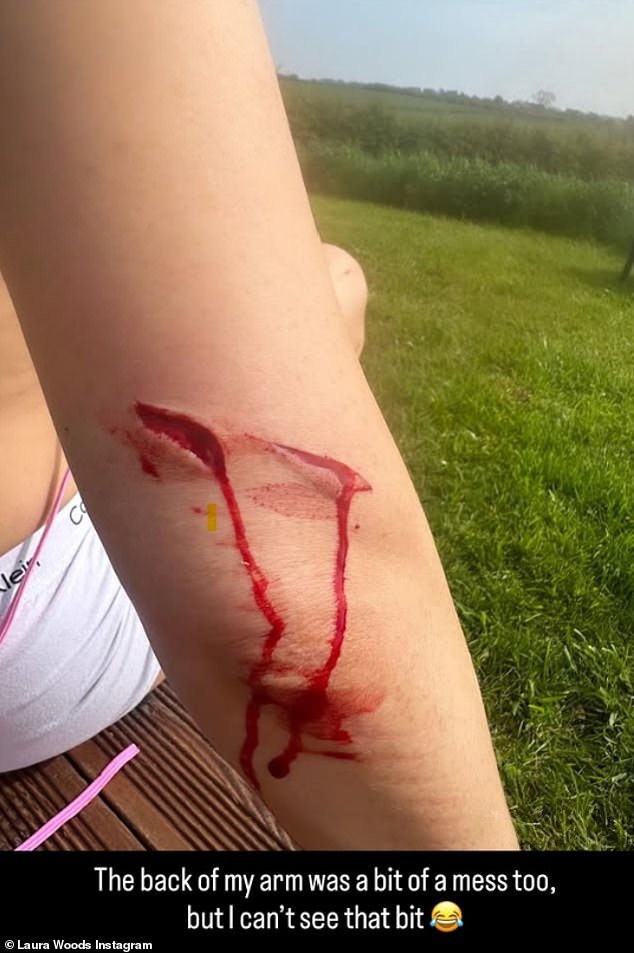 One picture showed Woods bleeding from her right elbow, with the caption: 'The back of my arm was a bit of a mess too, but I can't see that bit'