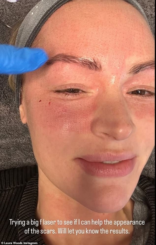 'Trying a big f laser to see if I can help the appearance of the scars,' she captioned another candid selfie