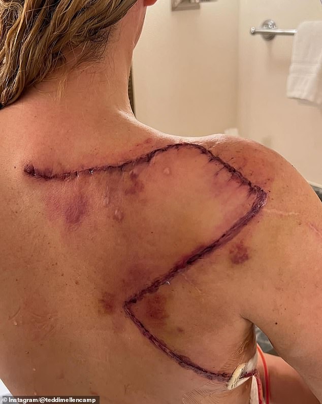 The Bravo alum has had a total of 17 melanomas removed from her back