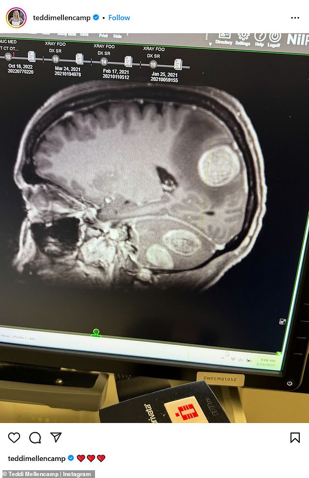 The reality star had four brain tumors removed last year. She has also undergone radiation and immunotherapy treatments