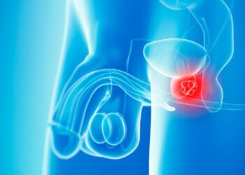 Prostate cancer overtakes breast as most common form of the disease