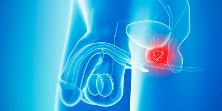 Prostate cancer overtakes breast as most common form of the disease