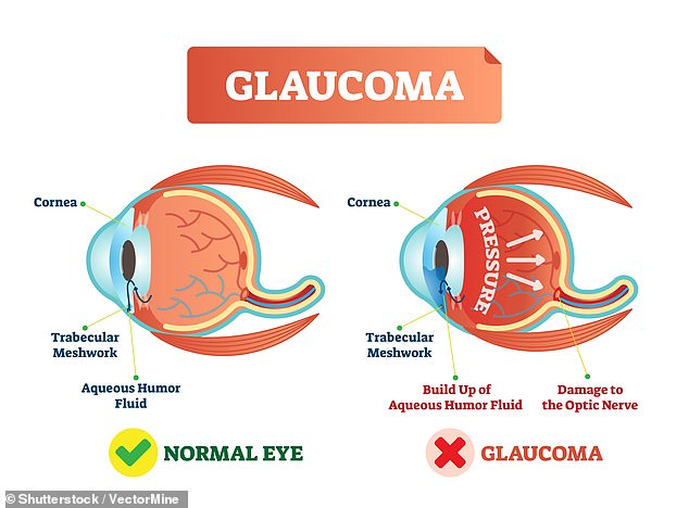 It's not always known why glaucoma occurs, but a person's risk is higher if they are over 50, have a brother, sister or parent with the condition or have other medical conditions such as diabetes