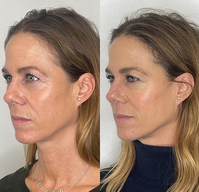 Laura Gee's before and after pictures. 'Dr Ivy made me feel gorgeous before she even picked up a needle,' she adds