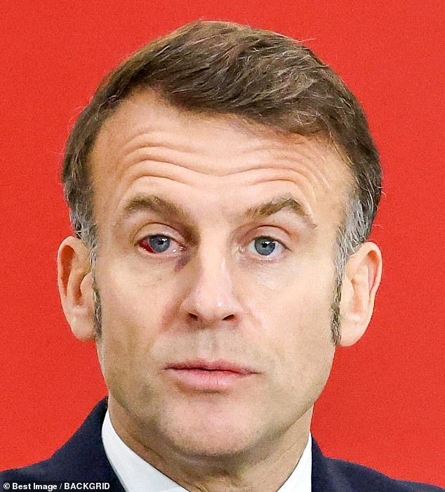 Speaking to the Daily Mail, consultant ophthalmologist Mr Mfazo Hove confirmed that, in photos, it does appear the Mr Macron has what is known as a subconjunctival haemorrhage