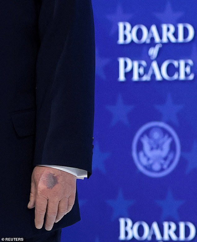 The bruise was seen on Trump's left hand as he attended the 'Board of Peace' meeting at the annual gathering of global business and political leaders in the Swiss town of Davos