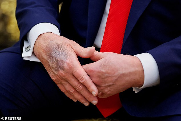 The bruised right hand of Trump is visible during a meeting with South Korean President Lee Jae Myung at the Oval Office, at the White House, in Washington, D.C., U.S., August 25, 2025