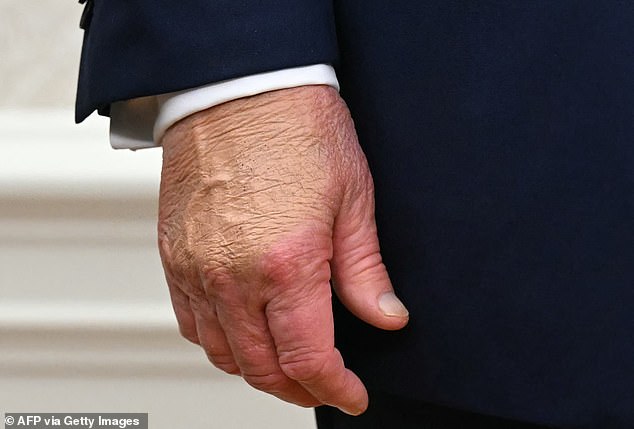 Trump's right hand has previously been pictured bruised and with globs of makeup that Press Secretary Karoline Leavitt says concealed bruises he sustained for shaking hands