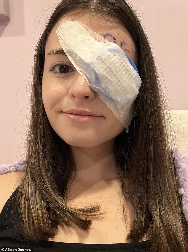 Pictured: Dashow, now 29, after her surgery with a covering over the eye affected by ocular melanoma, which she wore for seven days