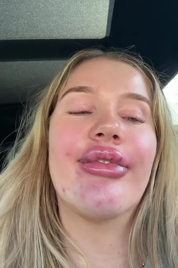 A woman with swollen, bruised lips and red skin around her chin.