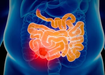 New improved NHS bowel cancer test is still quick, simple and done at home