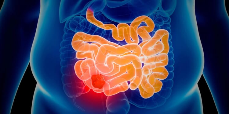 New improved NHS bowel cancer test is still quick, simple and done at home