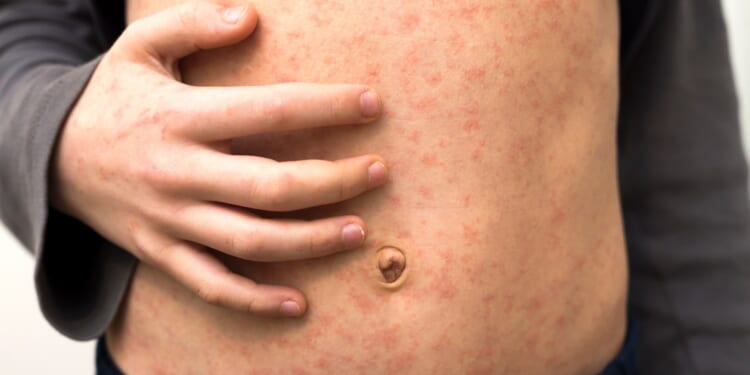 UK stripped of 'measles-free' status after cases hit record-high and jab uptake slumps