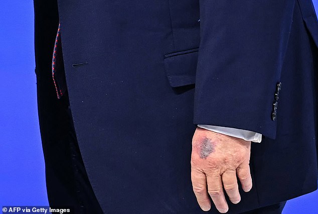 A new bruise appeared on President Donald Trump's left hand during his trip last week to Davo, Switzerland to attend the World Economic Forum. The White House said he hit his hand on a table at the Board of Peace event and it bruises easily due to Aspirin use