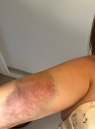 A Spanish court heard Ms Childs was left with painful bruising to her arm