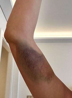 A Spanish court heard Ms Childs was left with painful bruising to her arm