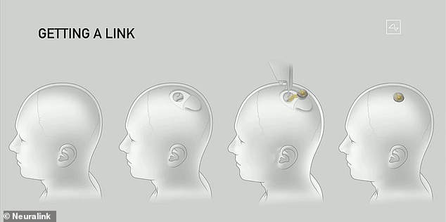 The procedure itself was carried out by the company's R1 surgical robot, designed to insert microscopic electrodes into delicate brain tissue with extreme precision