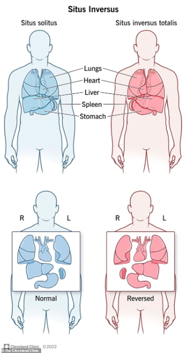 The above graphic shows normal anatomy (left, situs solitus) and the flipped anatomy (right) that is observed in people with situs inversus