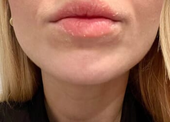 Hannah Skelley has suffered from eczema since childhood, and remembers struggling to find skincare that helped her