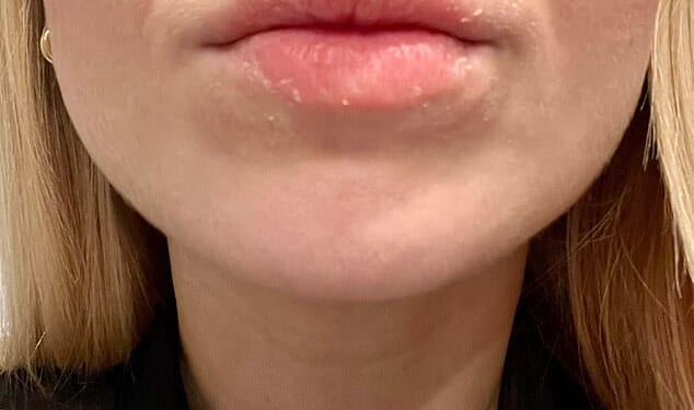 Hannah Skelley has suffered from eczema since childhood, and remembers struggling to find skincare that helped her