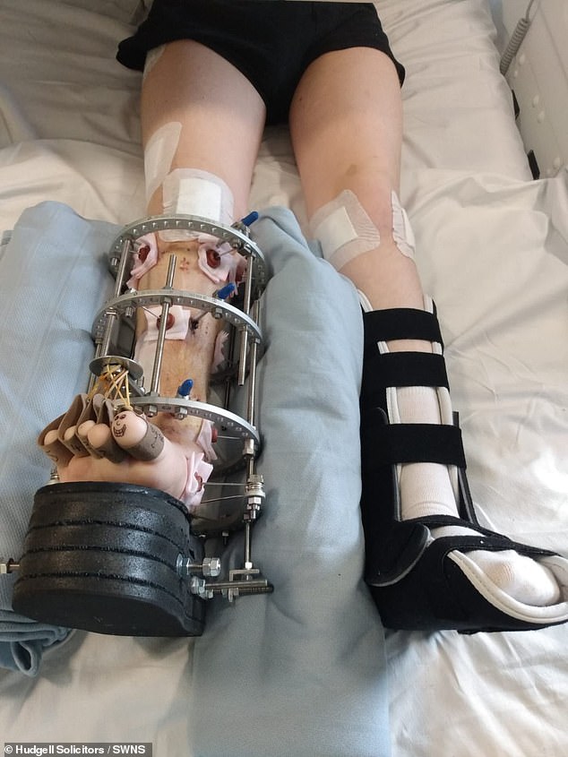 A teenage boy was forced to have his leg amputated after he felt his bone 'snap' just months after surgeon Yaser Jabbar operated on it