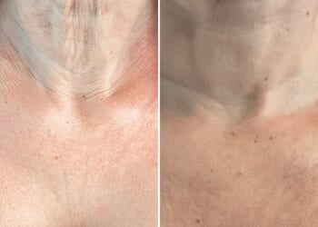 Olivia Falcon's neck when she was on Ozempic (left) and after deploying her top tips to rid the saggy skin (right)